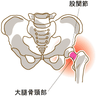 大腿骨骨折説明図