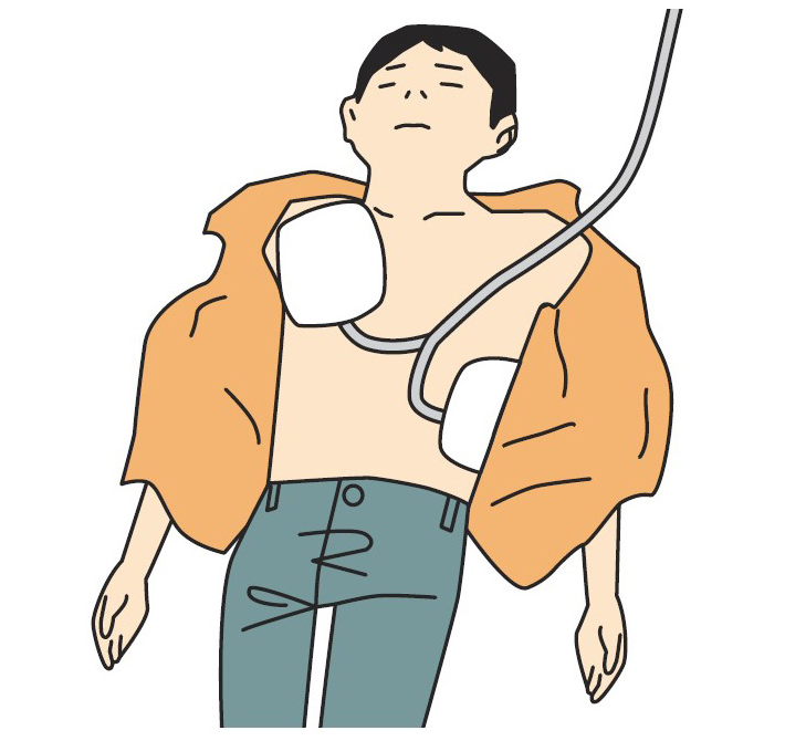 電極パッドを装着した人の図