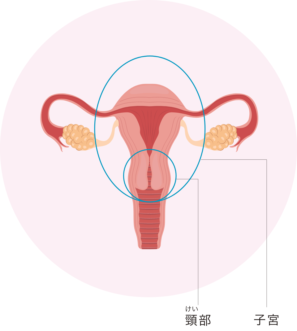 子宮頸がんと新たに診断された女性の数（2020年）