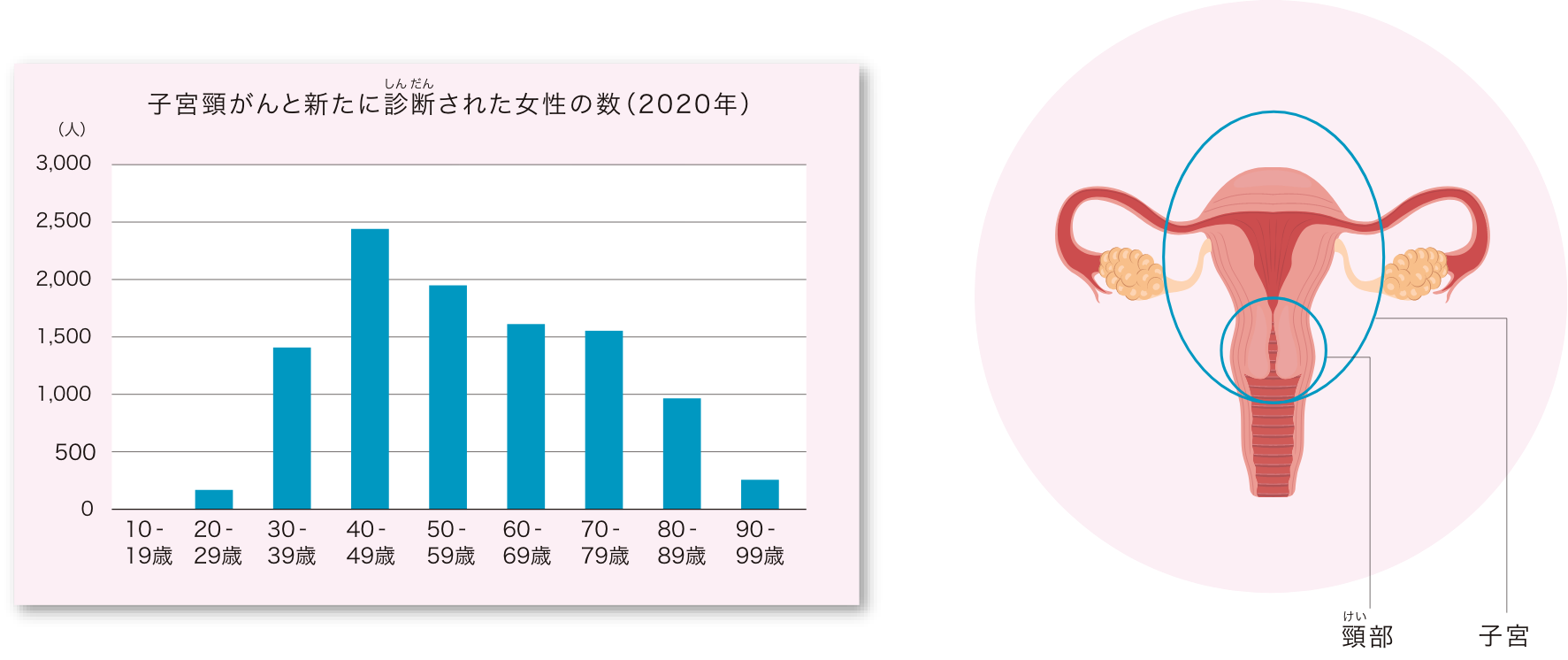 子宮頸がんと新たに診断された女性の数（2020年）