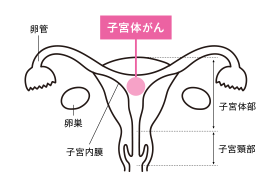 「子宮体がん」とは？