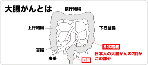 大腸内のがん発生箇所を示す図