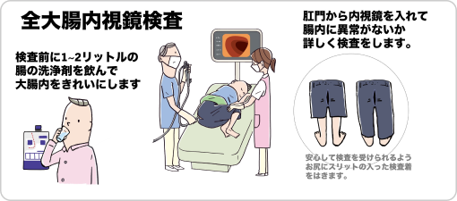 全大腸内視鏡検査のイメージ画像
