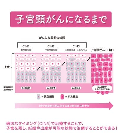 子宮頸がんになるまで