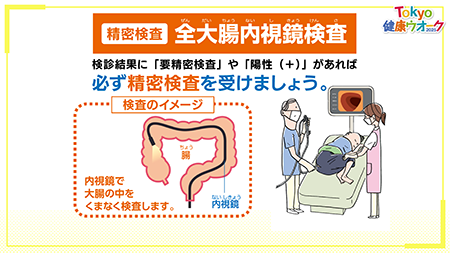 精密検査：全大腸内視鏡検査の画像
