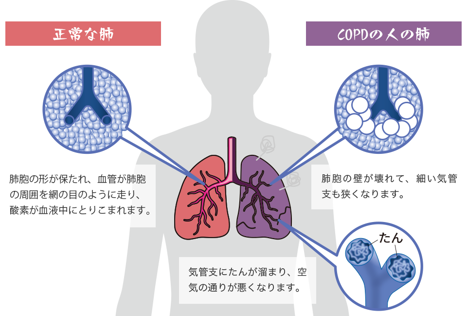 正常な肺 肺胞の形が保たれ、血管が肺胞の周囲を網の目のように走り、酸素が血液中にとりこまれます。 COPDの人の肺 肺胞の壁が壊れて、細い気管支も狭くなります。気管支にたんが溜まり、空気の通りが悪くなります。