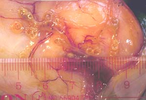 Figure: Anisakis